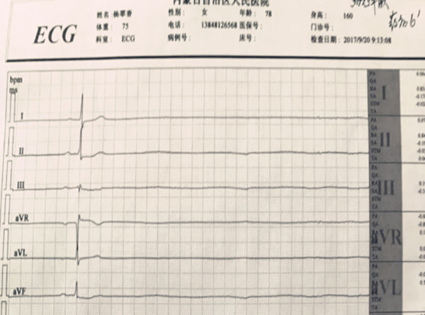 心电图(1).jpg
