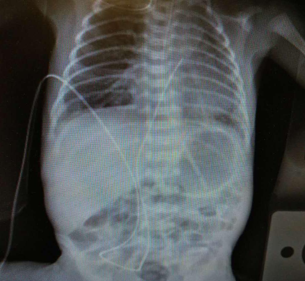 脐静脉置管图片