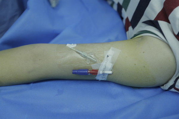 我院成功完成自治区首例隧道式picc置管术