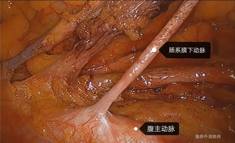 裸化肠系膜下动脉根部保留左结肠动脉清扫253淋巴结直肠全系膜切除术